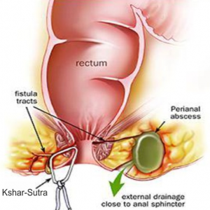 ksharsutra