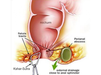 ksharsutra